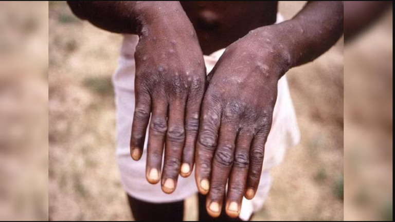 India Records The First Suspected Mpox Case, A Male Patient In Isolation.